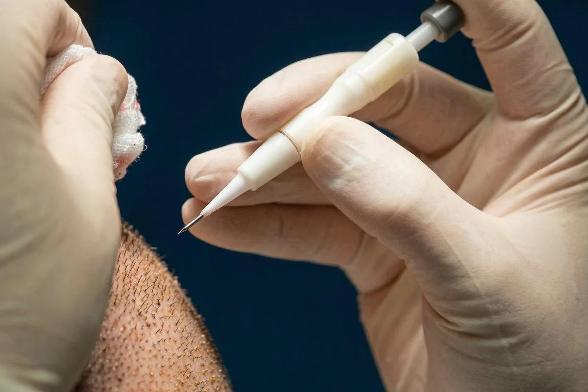 DHI implantasyon kalemi (Choi implanter) ile saç kökünün yerleştirilmesi